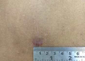 प्राग, चेक गणराज्य की राजधानी  में न्यूरो सर्जन को डेमेंस्ट्रेशन देने के लिए डॉ महेश रमोला को किया आमंत्रित