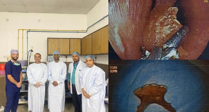 बड़ी खबर: श्री महंत इन्दिरेश अस्पताल के गैस्ट्रोइंट्रोलाॅजिस्ट ने मरीज़ की आहारनली से निकाला डेंचर..