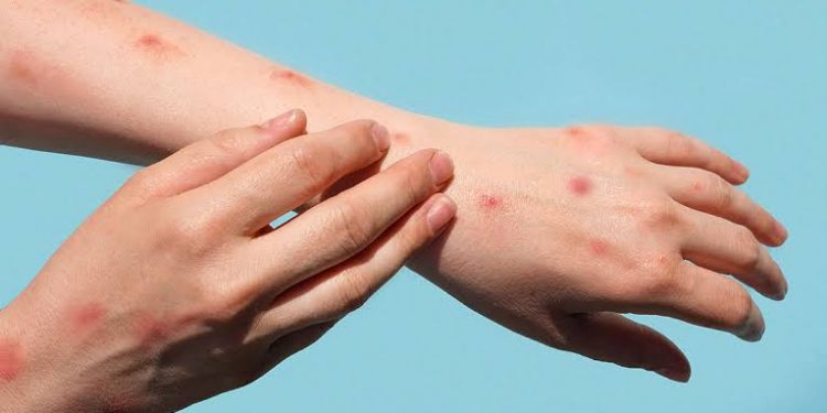 बड़ी खबर: मंकी पॉक्स को लेकर उत्तराखंड में अलर्ट जारी