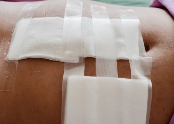 सिजेरियन डिलीवरी के बाद महिला की दर्दनाक मौत, पेट में छूटी कॉटन पट्टी से फैला संक्रमण