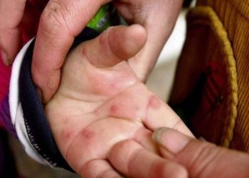 टोमेटो फ्लू अलर्ट उत्तराखंड: 3 जिलों में एडवाइजरी, सितारगंज में 28 बच्चे संक्रमित