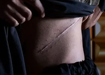 देहरादून में पढ़ रहे छात्र ने पैसों के लिए बेच डाली किडनी, अस्पताल मालिक और 06 चिकित्सक गिरफ्त में